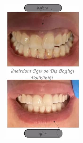 Diş taşı temizliği öncesi ve sonrası